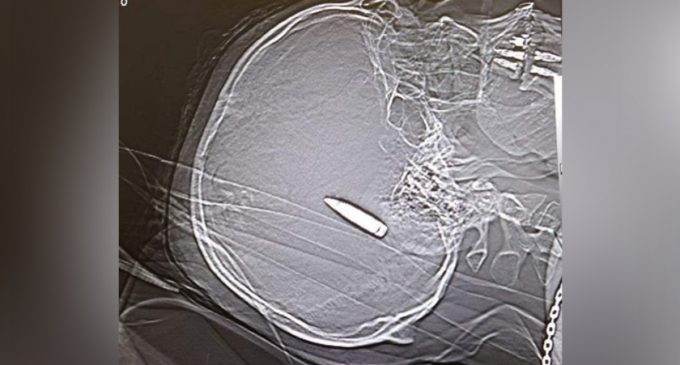 У Дніпрі рятують 35-річного чоловіка, у якого посеред мозку застрягла куля